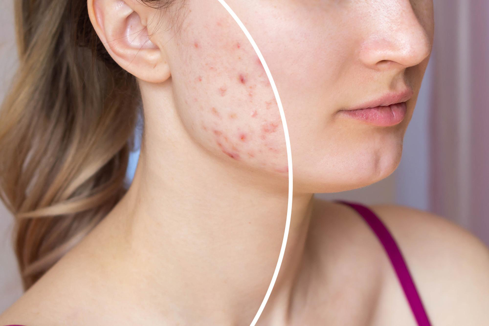 Cos’è l’acne e perché alcune persone ne sono più interessate